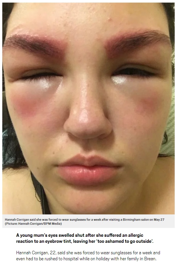 眉ティントでアレルギー反応が出てしまった女性（画像は『Metro　2018年6月5日付「Mum ‘too ashamed to go outside’ after eyebrow tint swelled her eyes shut」（Picture: Hannah Corrigan/BPM Media）』のスクリーンショット）