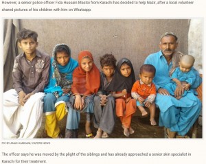 【海外発！Breaking News】手足の皮膚が石化　稀な皮膚疾患の子供4人を抱える両親（パキスタン）