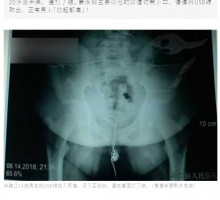 【海外発！Breaking News】好奇心旺盛な13歳少年、スマホ充電ケーブルを性器に刺し込み病院へ（中国）