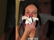 【海外発！Breaking News】整形手術で変形した鼻をヒルに血を吸わせて治療する女性（米）＜動画あり＞