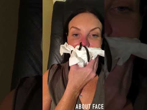 整形に失敗した鼻の治療にヒルを使用する女性（画像は『About Face by Shari　2018年6月13日公開 YouTube「First Time Leeching Review by Shari Manchon」』のサムネイル）