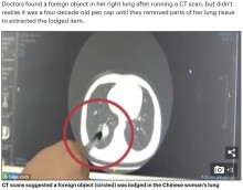 【海外発！Breaking News】小学生の頃にペンのキャップを誤飲した女性　40年後に肺から摘出（中国）