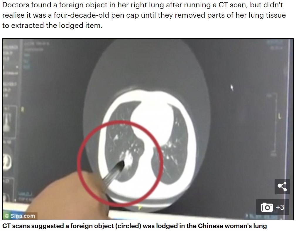 肺に40年間入ったままだったペンのキャップ（画像は『Daily Mail Online　2018年8月15日付「Woman has a pen cap lodged in her lung for 40 years after accidentally swallowing it as a child」（（C）Sina.com）』のスクリーンショット）