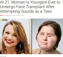 【海外発！Breaking News】10代で自殺未遂後、顔が損傷した女性　米国で最も若い顔面移植患者に
