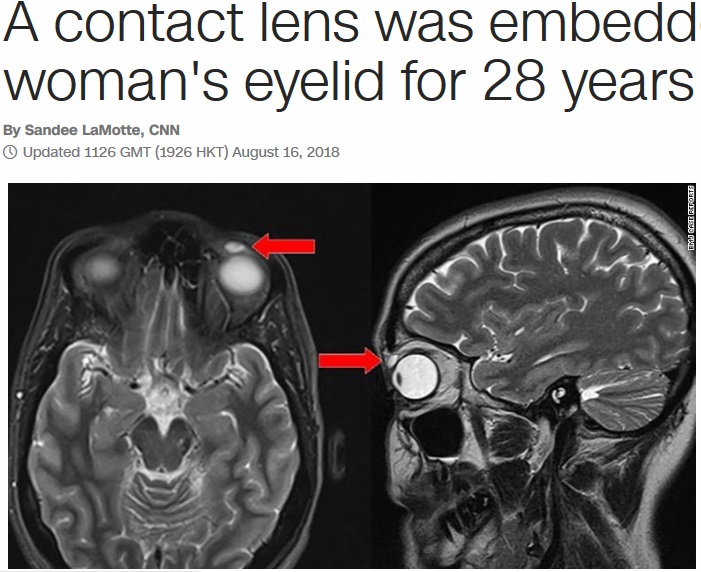 紛失したとばかり思っていたコンタクトレンズが28年間、瞼の裏側に…（画像は『CNN　2018年8月16日付「A contact lens was embedded in woman’s eyelid for 28 years」（BMJ Case Reports）』のスクリーンショット）