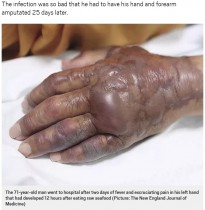【海外発！Breaking News】寿司を食べた71歳男性、25日後に食中毒菌が原因で腕を切断（韓国）　