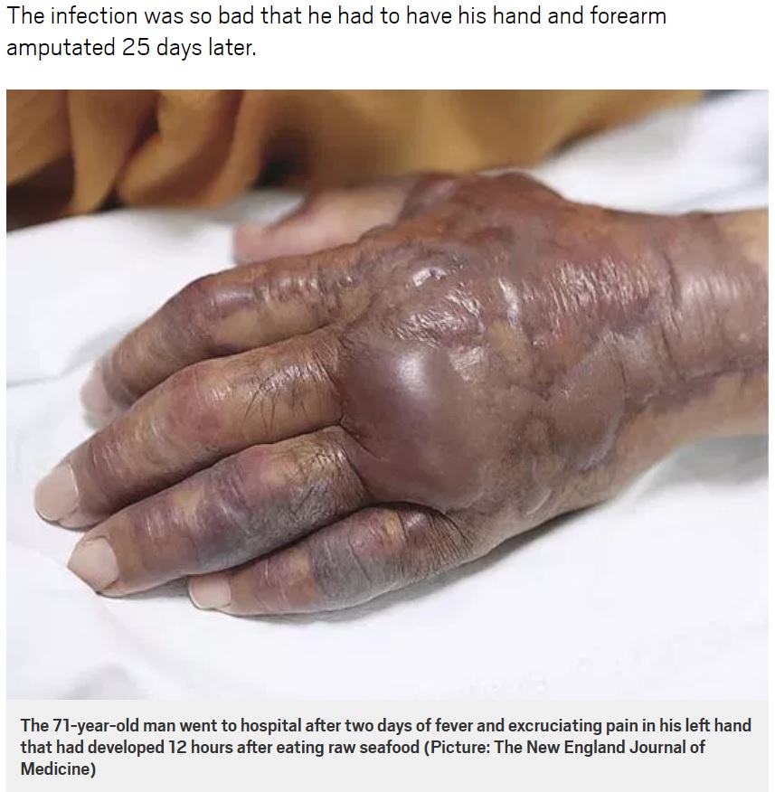 寿司を食べて細菌感染した男性、手が壊死し切断する羽目に（画像は『Metro　2018年8月29日付「Man, 71, had hand amputated when skin started rotting 12 hours after eating sushi」（Picture: The New England Journal of Medicine）』のスクリーンショット）