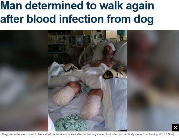 犬の唾液から感染症になり四肢を切断した男性（画像は『WNYW（FOX 5）　2018年10月3日付「Man determined to walk again after blood infection from dog」（Fox 6 Now）』のスクリーンショット）