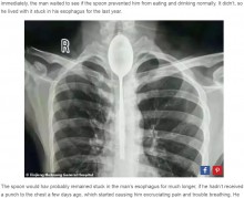【海外発！Breaking News】20cmのスプーンを食道に放置したまま1年間過ごしていた男性（中国）