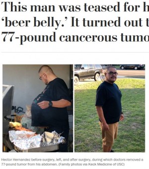 【海外発！Breaking News】“ビール腹”とからかわれていた男性、35kgの悪性腫瘍を摘出（米）