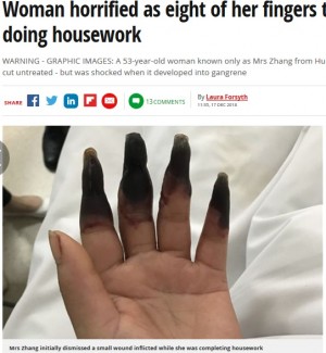 【海外発！Breaking News】小さな切り傷を放置し家事を続けた女性、8本の指が壊疽に（中国）