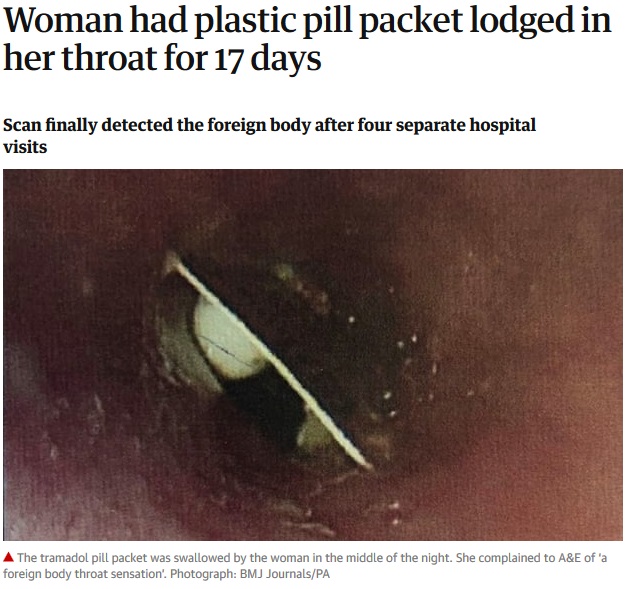 食道上部に錠剤パッケージが詰まったままに…（画像は『The Guardian　2019年1月16日付「Woman had plastic pill packet lodged in her throat for 17 days」（Photograph: BMJ Journals/PA）』のスクリーンショット）
