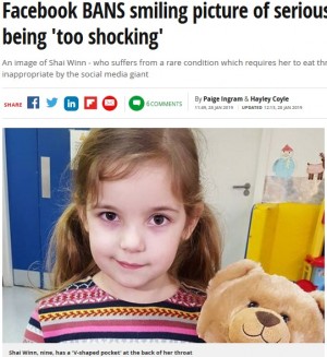 【海外発！Breaking News】稀な病で鼻にチューブを通した少女の写真を「過激」と削除　Facebookに母親怒り（英）