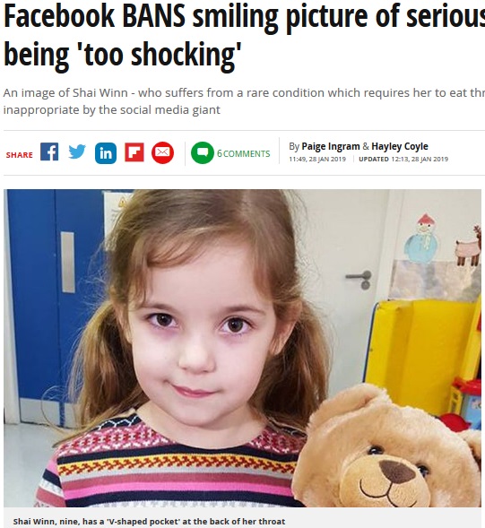 稀な疾患を抱えて生活する9歳少女（画像は『Mirror　2019年1月29日付「Facebook BANS smiling picture of seriously ill girl, 9, for being ‘too shocking’」』のスクリーンショット）