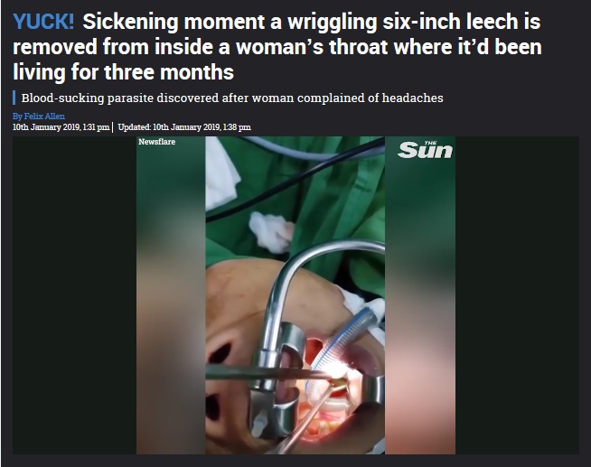女性の喉から巨大ヒルが取り出される（画像は『The Sun　2019年1月10日付「YUCK! Sickening moment a wriggling six-inch leech is removed from inside a woman’s throat where it’d been living for three months」（Newsflare）』のスクリーンショット）