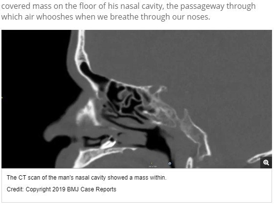 鼻の奥に歯が生えていた男性のCTスキャン画像（画像は『Live Science　2019年2月27日付「A Man’s Trouble Smelling Was Caused By a Tooth Growing in His Nose」（Credit: Copyright 2019 BMJ Case Reports）』のスクリーンショット）