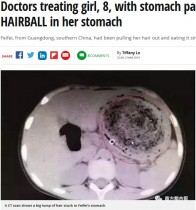 【海外発！Breaking News】腹痛を訴えた8歳少女、胃に1.4kgの毛髪の塊（中国）