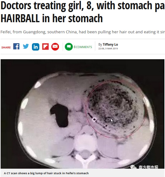 6年間食べ続けていた毛髪が胃の中に（画像は『Mirror　2019年3月3日付「Doctors treating girl, 8, with stomach pain find 3lb HAIRBALL in her stomach」』のスクリーンショット）
