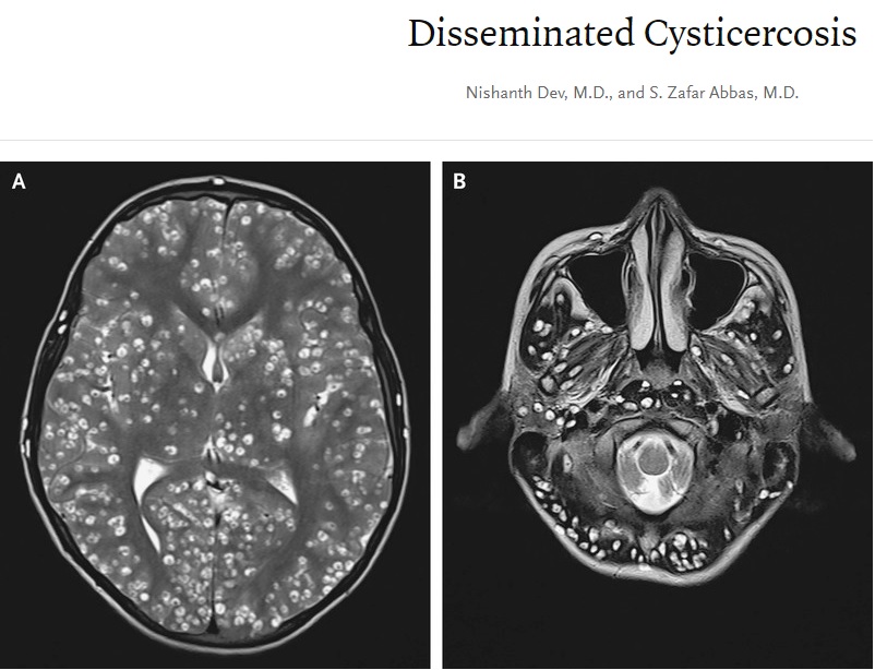 大脳皮質（右）と脳幹・小脳に多数の嚢胞がみられた少年（画像は『The New England Journal of Medicine　2019年3月28日付「Disseminated Cysticercosis」』のスクリーンショット）
