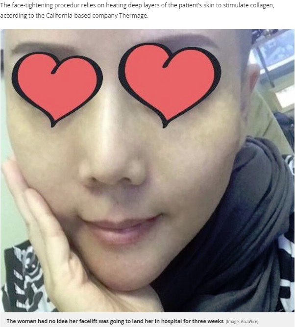 施術前の50代女性（画像は『Mirror　2019年4月23日付「Woman’s face left covered in blisters after botched plastic surgery」（Image: AsiaWire）』のスクリーンショット）