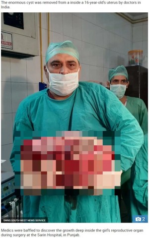 【海外発！Breaking News】16歳少女の子宮から15キロの腫瘍が摘出される（印）