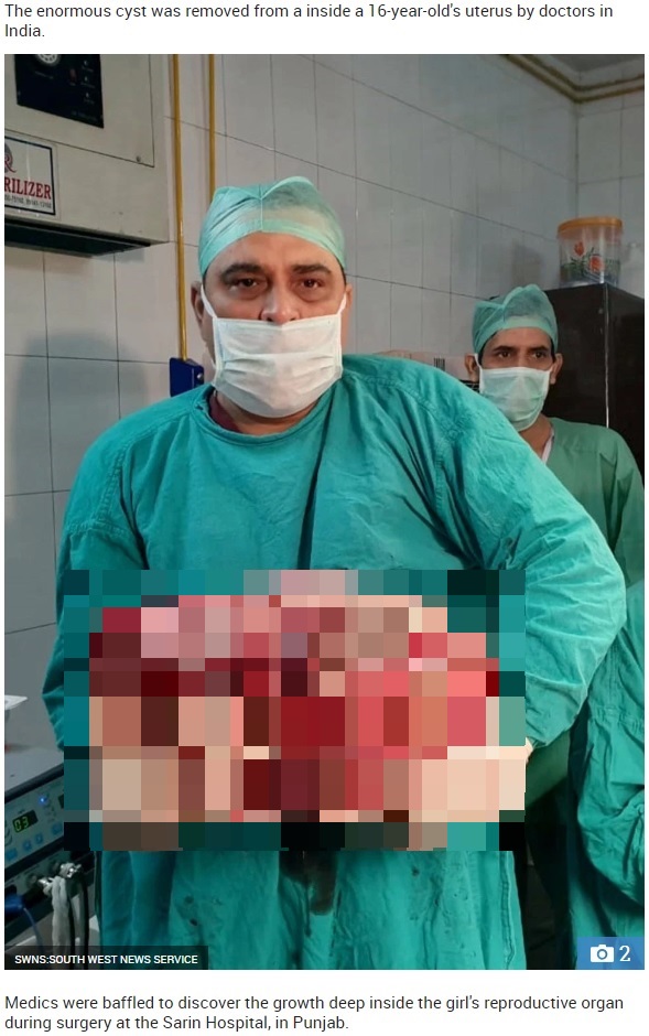 少女の子宮から摘出された15キロの腫瘍（画像は『The Sun　2019年4月22日付「GRUESOME GROWTH Doctors remove huge 15kg tumour from inside 16-year-old girl’s womb」（Credit: SWNS:SOUTH WEST NEWS SERVICE）』のスクリーンショット　画像を一部加工しています）