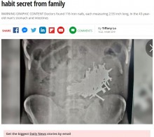 【海外発！Breaking News】家族に内緒で鉄釘を食べ続けた男性、胃から116本を摘出（印）