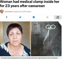 【海外発！Breaking News】23年間体内に手術器具を残存　62歳女性「長年痛みに苦しんだ」と怒り（露）