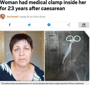 【海外発！Breaking News】23年間体内に手術器具を残存　62歳女性「長年痛みに苦しんだ」と怒り（露）