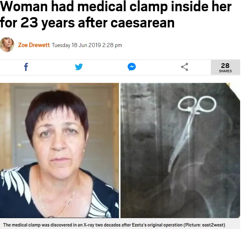女性の腹部に放置されていた鉗子（画像は『Metro　2019年6月18日付「Woman had medical clamp inside her for 23 years after caesarean」（Picture: east2west）』のスクリーンショット）