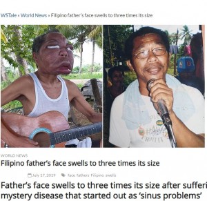 【海外発！Breaking News】副鼻腔炎と診断されるも原因不明　顔が3倍に腫れ上がってしまったフィリピンの男性