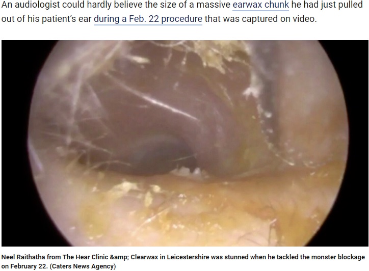 男性の耳の中に大量の耳垢が発見される（画像は『FOX News　2019年6月19日付「Earwax clump clogging entire ear canal removed from patient: ‘Look at that!’」（Caters News Agency）』のスクリーンショット）