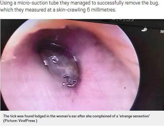 耳の中で発見されたマダニ（画像は『Metro　2019年6月28日付「The horrific moment a tick is pulled from a woman’s ear after complaining about tinnitus」（Picture: ViralPress）』のスクリーンショット）