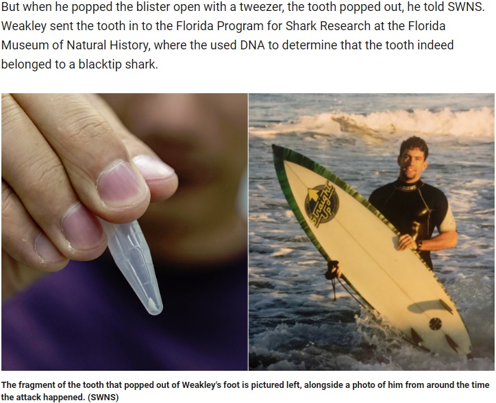 見つかったサメの歯とそれを長年体内に抱えていた男性（画像は『Fox News　2019年7月6日付「hark tooth pulled from man’s foot 25 years after bite」（SWNS）』のスクリーンショット）