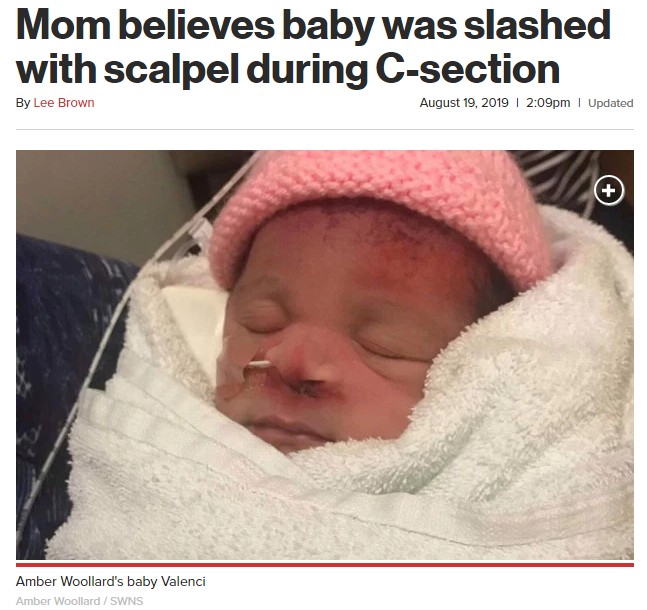 鼻に切り傷を持って生まれた新生児（画像は『New York Post　2019年8月19日付「Mom believes baby was slashed with scalpel during C-section」（Amber Woollard / SWNS）』のスクリーンショット）