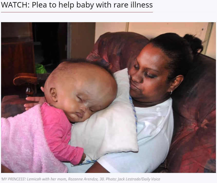 96センチの頭部をもつ生前のレミカちゃん（画像は『Daily Voice　2019年6月12日付「WATCH: Plea to help baby with rare illness」（Photo: Jack Lestrade/Daily Voice）』のスクリーンショット）