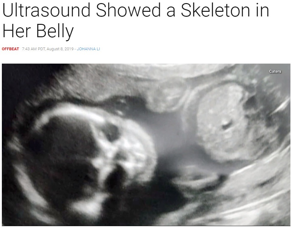 胎児のエコー写真に不気味なドクロが！（画像は『Inside Edition　2019年8月8日付「Pregnant Mom ‘Freaked Out’ When Ultrasound Showed a Skeleton in Her Belly」（Caters）』のスクリーンショット）