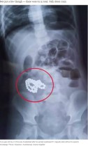 【海外発！Breaking News】マグネットボール61個を飲み込んだ6歳児　消化管を一部切除（中国）