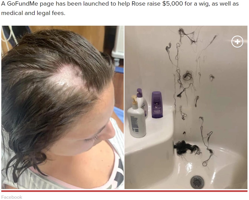 脱毛剤が混入したと思われるヘアコンディショナーを使った女性（画像は『New York Post　2019年8月1日付「Woman loses hair in clumps after Nair allegedly mixed into her conditioner」（Facebook）』のスクリーンショット）