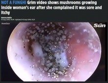 【海外発！Breaking News】耳の中に無数のキノコに見える真菌が繁殖した女性（ベトナム）＜動画あり＞