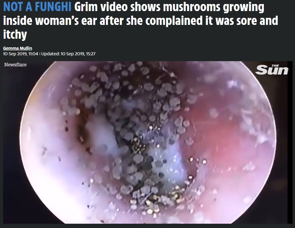 耳の中に無数のキノコのようなものが…（画像は『The Sun　2019年9月10日付「NOT A FUNGHI Grim video shows mushrooms growing inside woman’s ear after she complained it was sore and itchy」（Credit: newsflare）』のスクリーンショット）