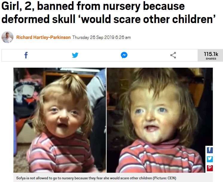 頭蓋骨が変形している2歳女児（画像は『Metro　2019年9月26日付「Girl, 2, banned from nursery because deformed skull ‘would scare other children’」（Picture: CEN）』のスクリーンショット）