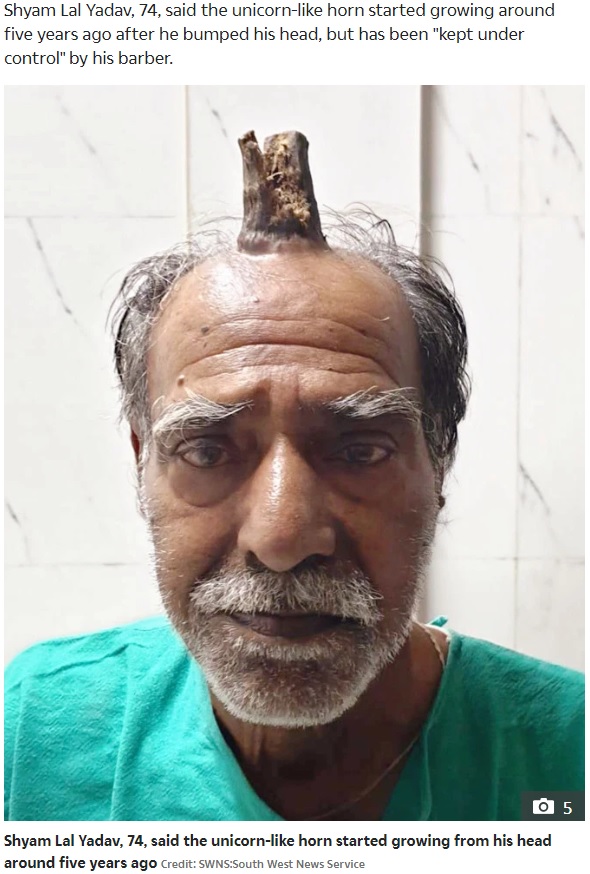 頭にユニコーンのような角を持つ74歳男性（画像は『The Sun　2019年9月18日付「LIFE OF HELL Terrifying four-inch ‘devil horn’ growing from the top of man’s head is finally removed by doctors」（Credit: SWNS:SOUTH WEST NEWS SERVICE）』のスクリーンショット）