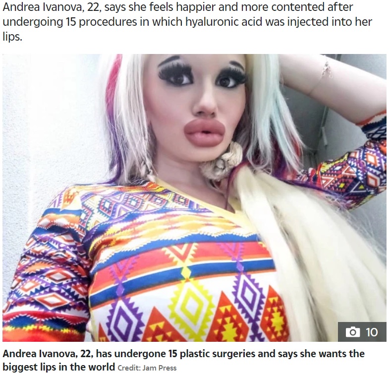 「世界一大きな唇」を目指す女性（画像は『The Sun　2019年9月20日付「LIP SERVICE Barbie-doll wannabe, 22, wants ‘the biggest lips in the WORLD’ after pumping them with acid」（Credit: JAM PRESS）』のスクリーンショット）