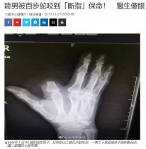 【海外発！Breaking News】毒ヘビに噛まれた指を慌てて切り落とした男性　「その必要はなかった」病院スタッフ（中国）