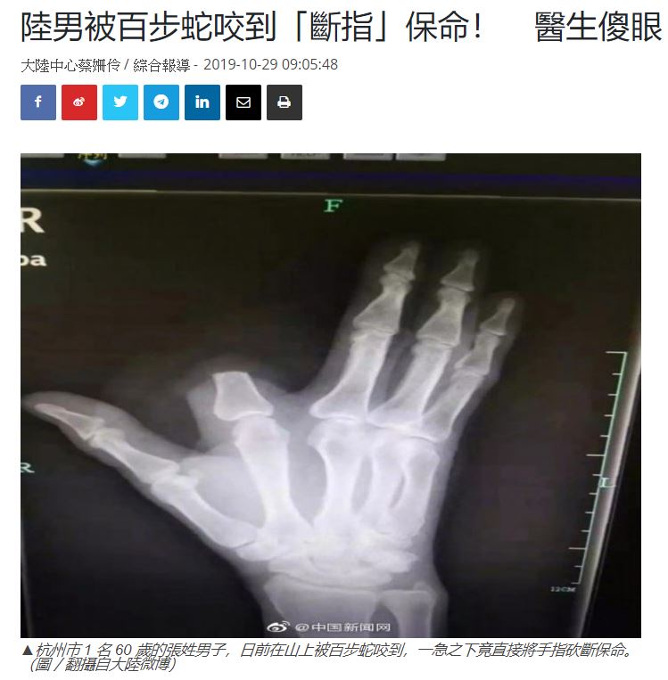 毒ヘビに噛まれた指を切り落とした男性（画像は『NOWnews 2019年10月29日付「陸男被百步蛇咬到「斷指」保命！　醫生傻眼：完全沒必要」（圖/翻攝自大陸微博）』のスクリーンショット）