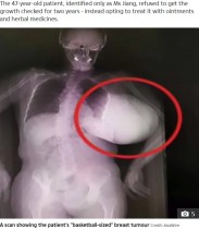【海外発！Breaking News】胸にバスケットボール大の腫瘍　47歳女性「漢方薬で対処していた」（中国）