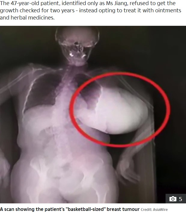 女性の胸にできた巨大な腫瘍（画像は『The Sun　2019年10月24日付「DEADLY DELAY Woman with breast tumour so big she had to hold it up finally goes to hospital after 2 years of herbal ‘treatments’」（Credit: AsiaWire）』のスクリーンショット）