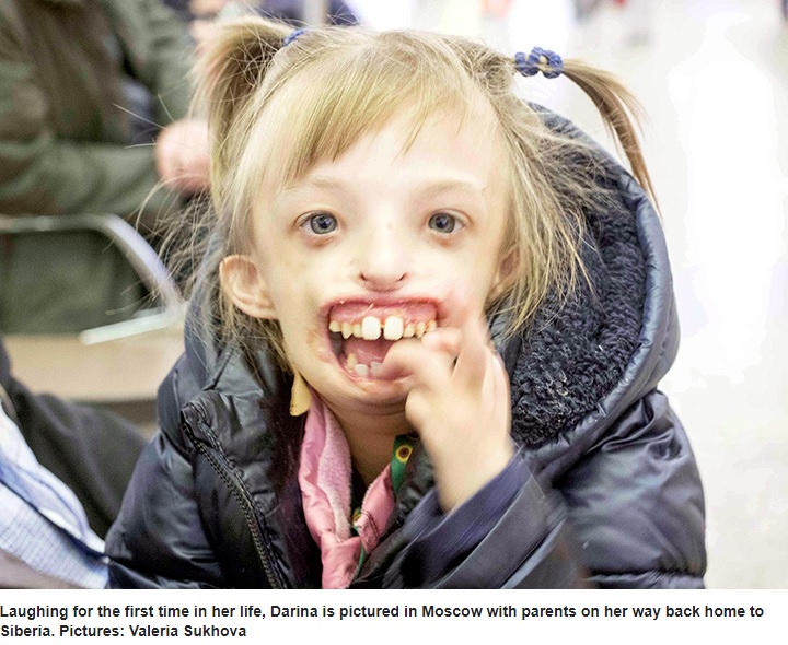 手術を受けて初めて笑顔を見せた6歳少女（画像は『Siberian Times　2019年10月3日付「Girl, 6, born without half her face returns to Russia laughing for first time after surgery in UK」（Pictures: Valeria Sukhova）』のスクリーンショット）