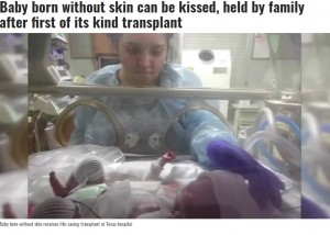【海外発！Breaking News】首から下の皮膚が欠損して誕生した赤ちゃん、生後10か月で母親から初めてのキス（米）